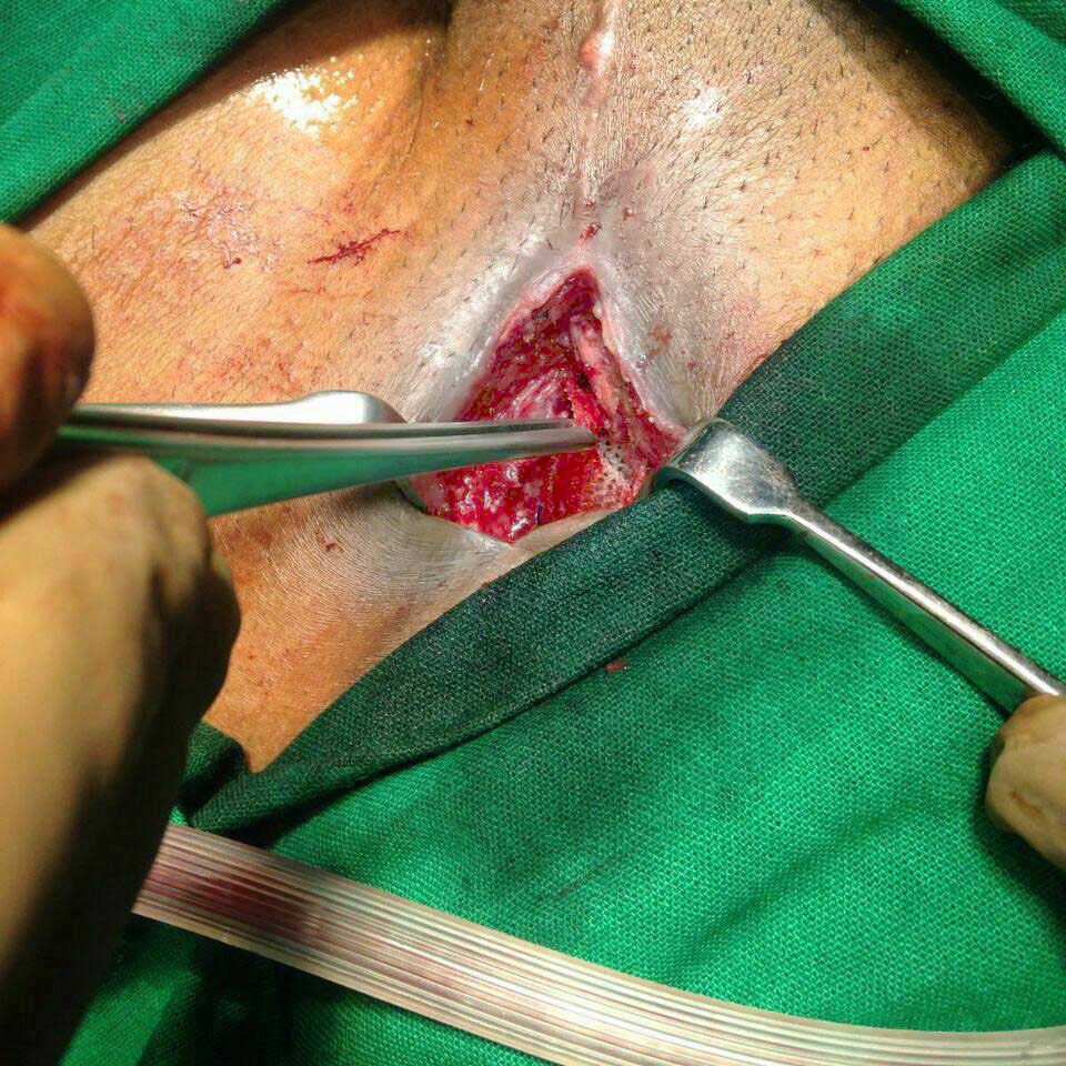 mesh infection treatment after conventional hernia surgery