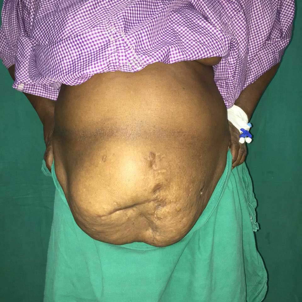 multiple ventral hernia before surgery