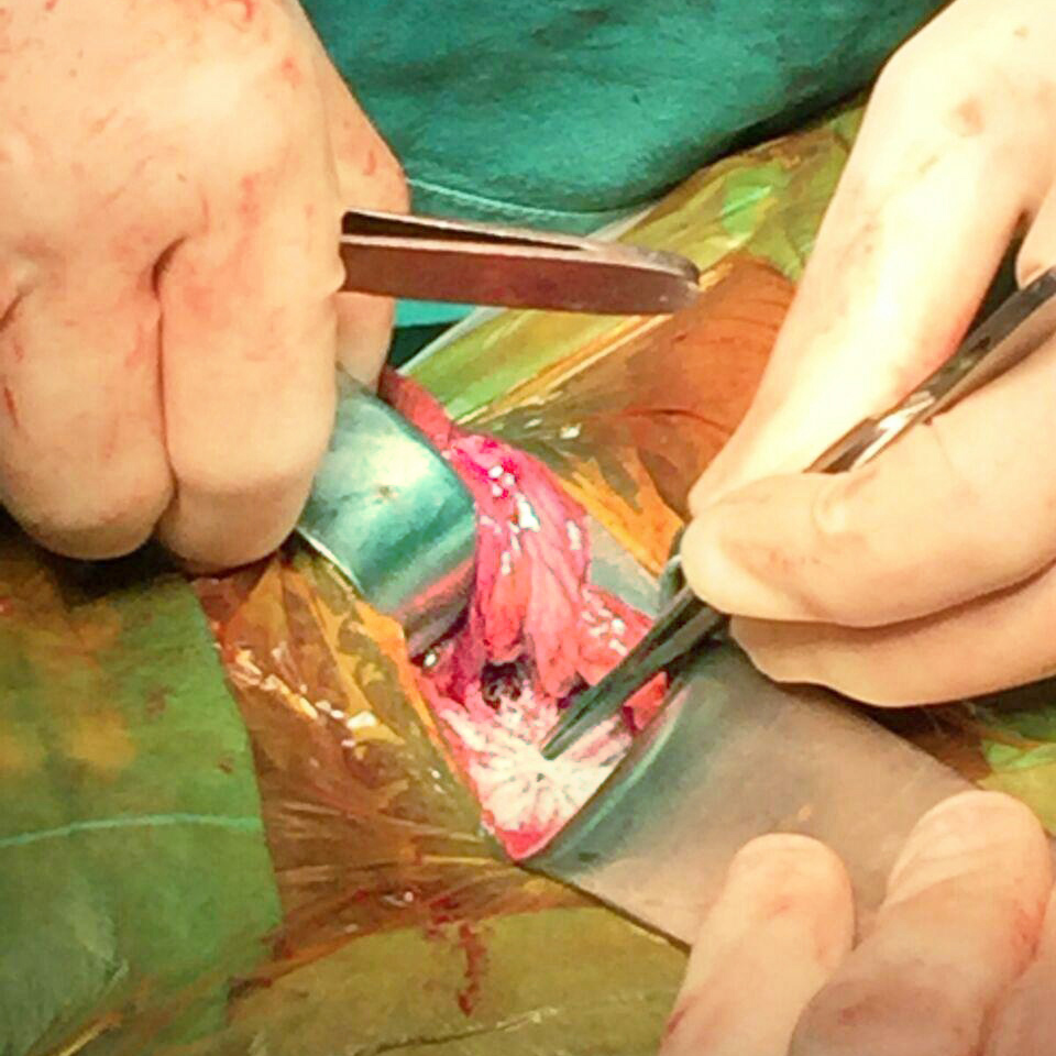 stitchless 3d hernia surgery