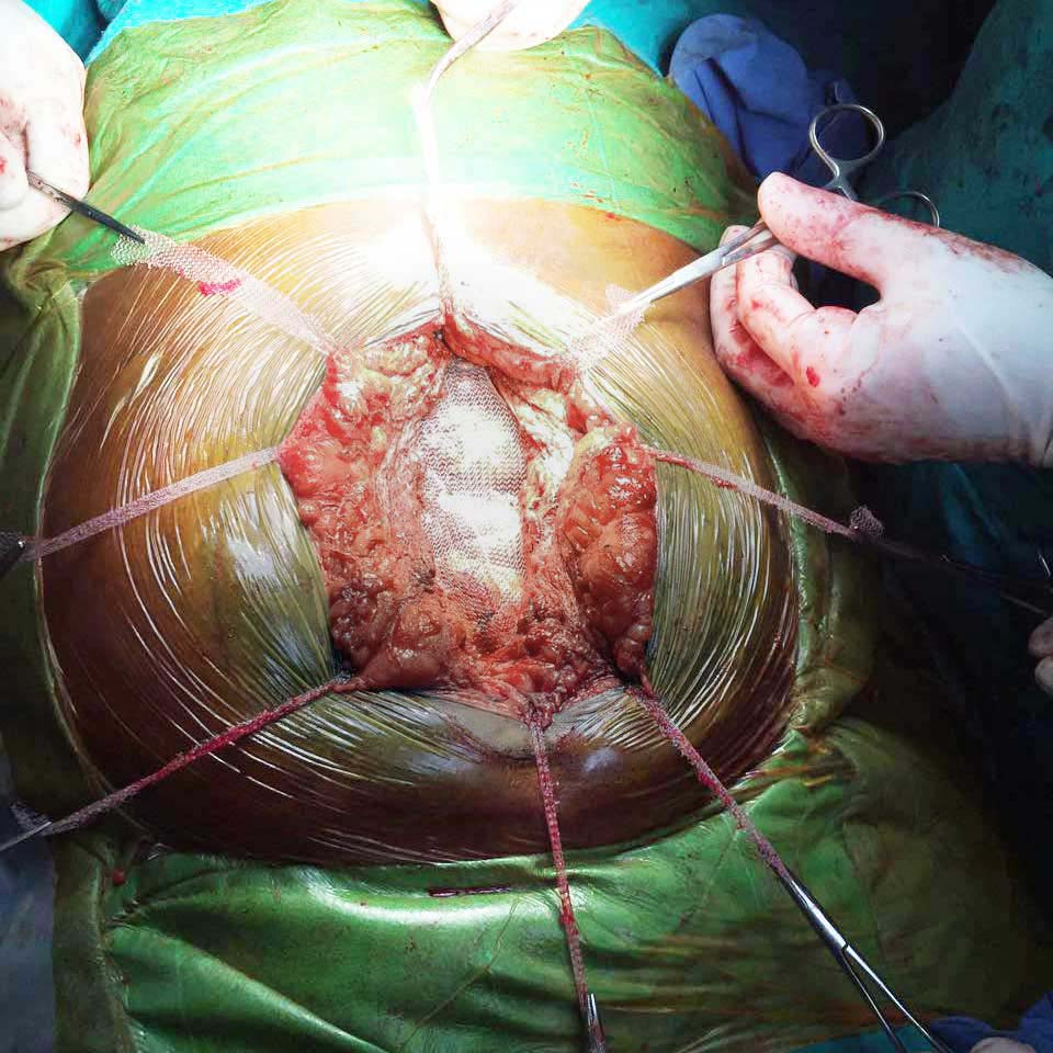 stitchless octomesh recurrent surgery